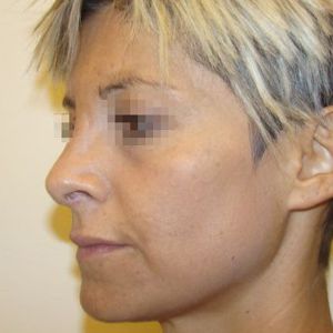 Rinoplastica: Costo paziente 1 dopo